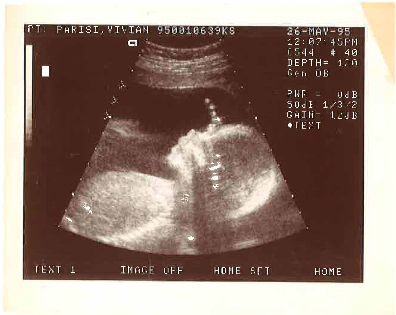 A sonogram image, labeled Vivian Parisi, from the 26th of may in 1995.